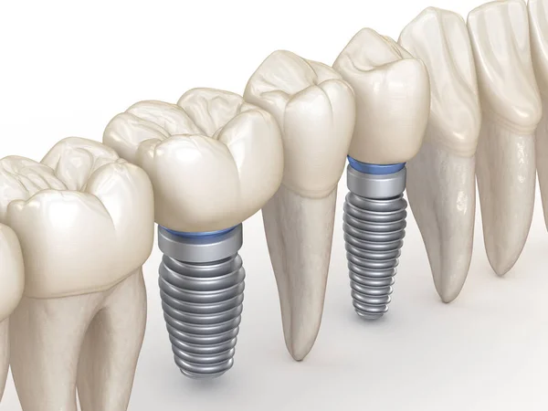 Meridian Dental Implants