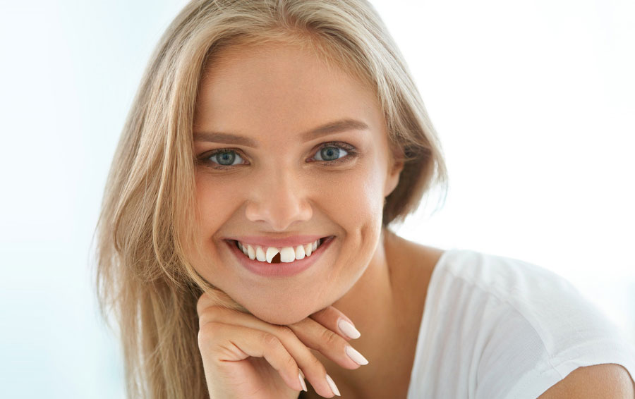 Cosmetic bonding for chipped teeth explained