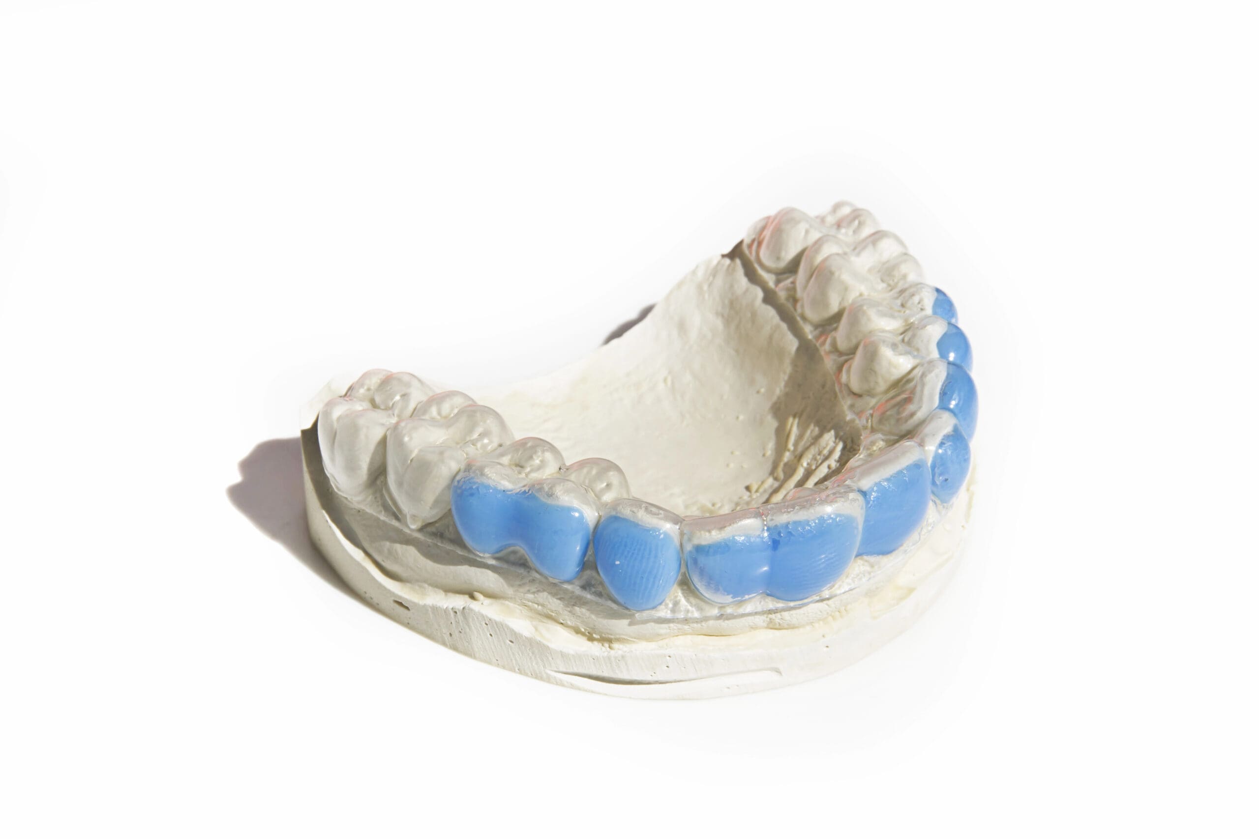 Affordable Dental Bridge Options: Choosing the Right Fit for Your Smile