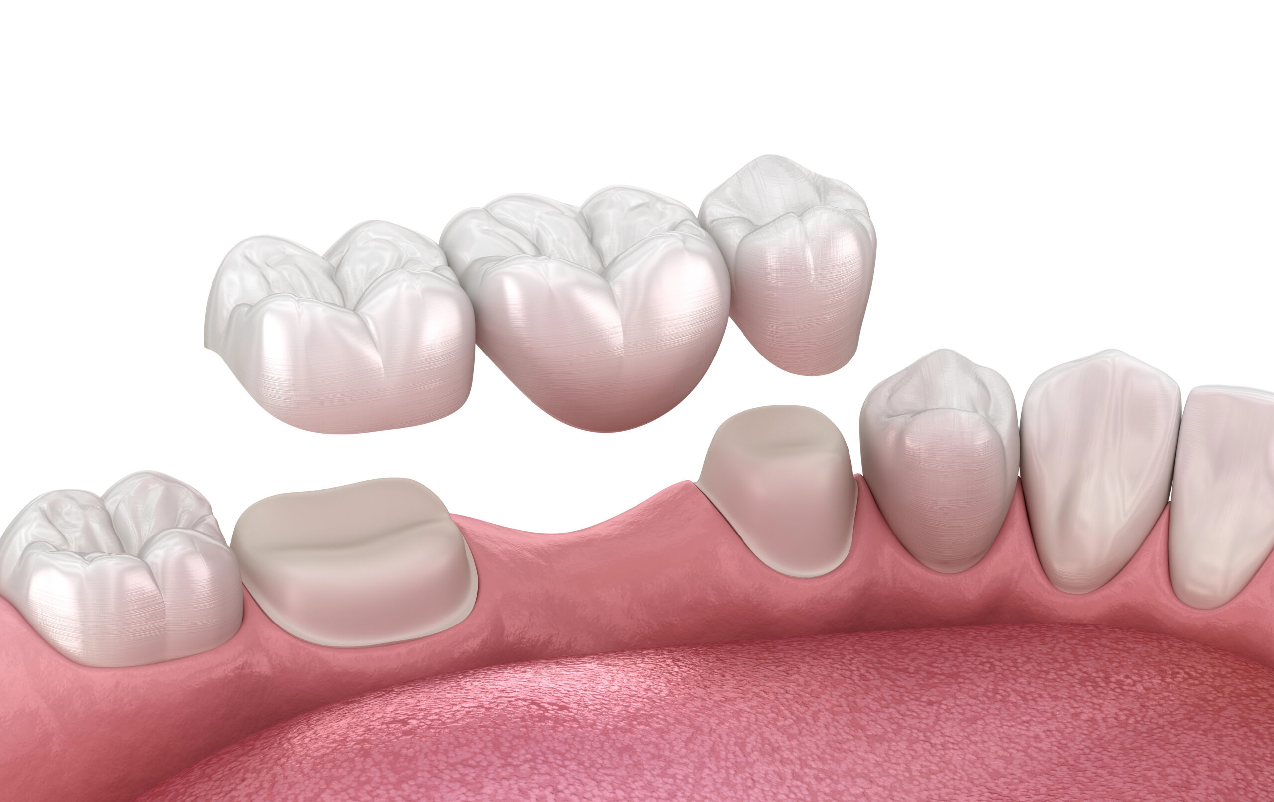 CEREC Crowns vs Traditional Crowns: What’s the Better Fit for You?