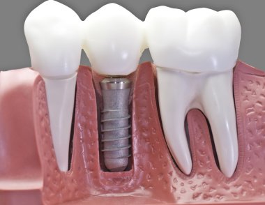 CEREC Crowns for Front Teeth: Natural-Looking Results in a Single Visit