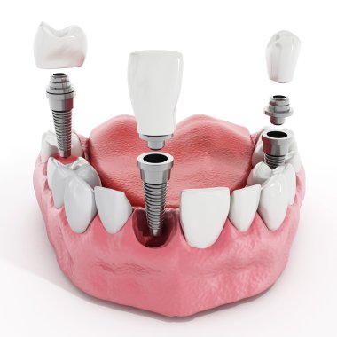 CEREC Crowns with Same Day Results: Instant Restoration, Lasting Quality