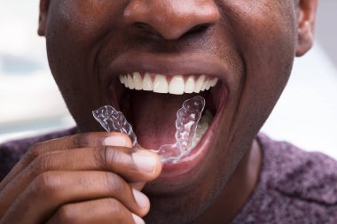 Clear Orthodontic Aligners: Discreet and Comfortable Treatment