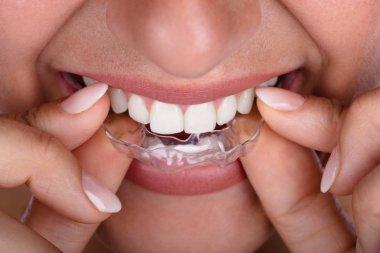 Orthodontics for Misaligned Teeth: Precise Solutions for a Perfect Smile