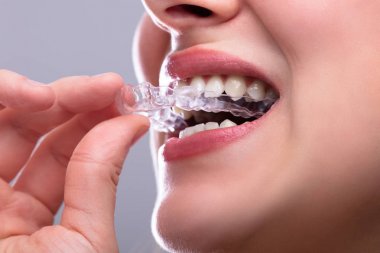 Affordable Orthodontic Care: Quality Alignment Without High Costs