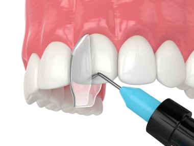 Tooth Bonding for Gaps: Closing Spaces with Confidence