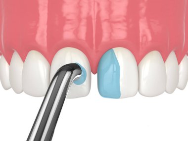 Tooth Bonding for Front Teeth: Restoring Your Smile’s Beauty