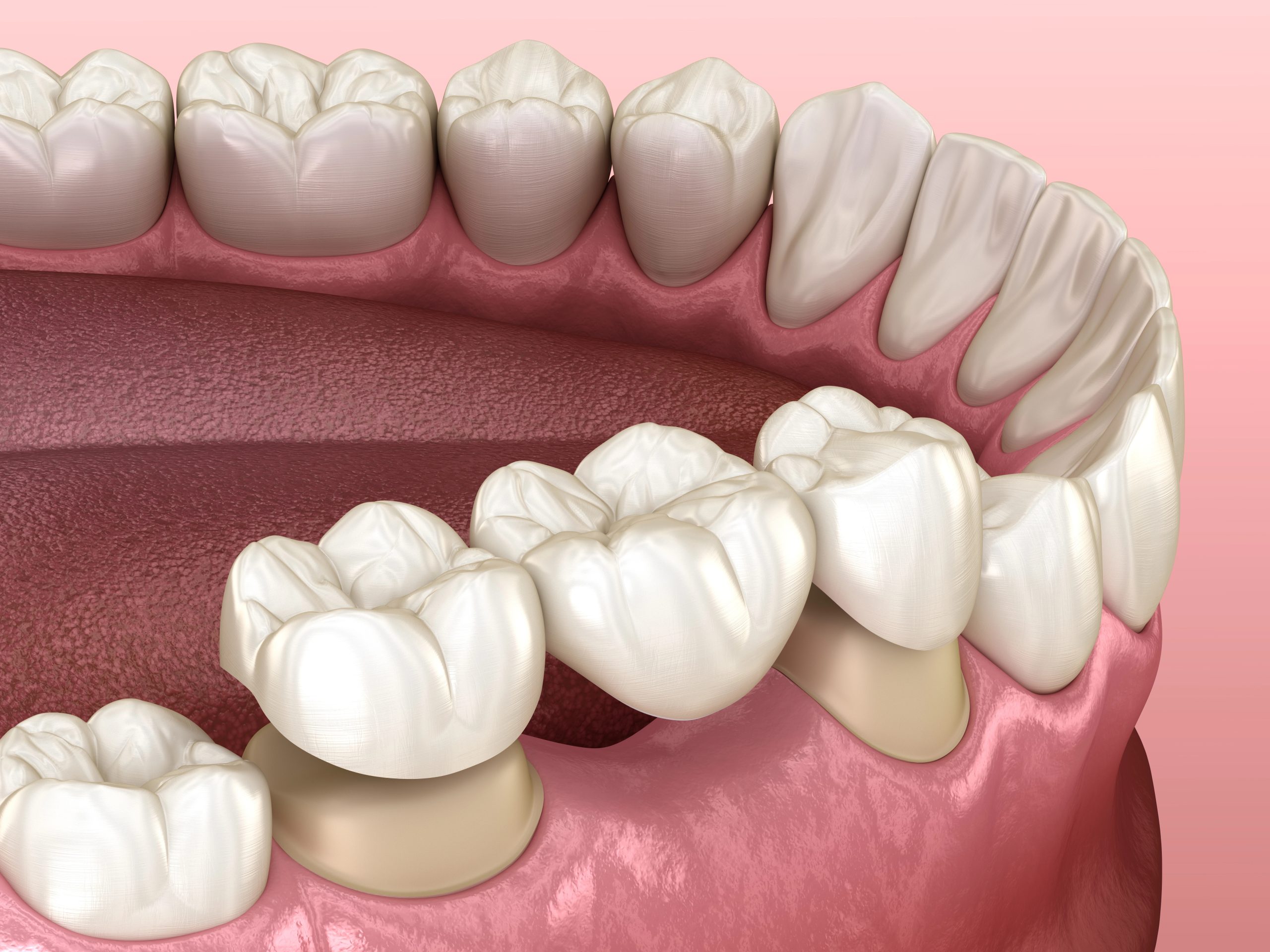 How Long Will Your Dental Bridge Last and Is It Worth the Investment?
