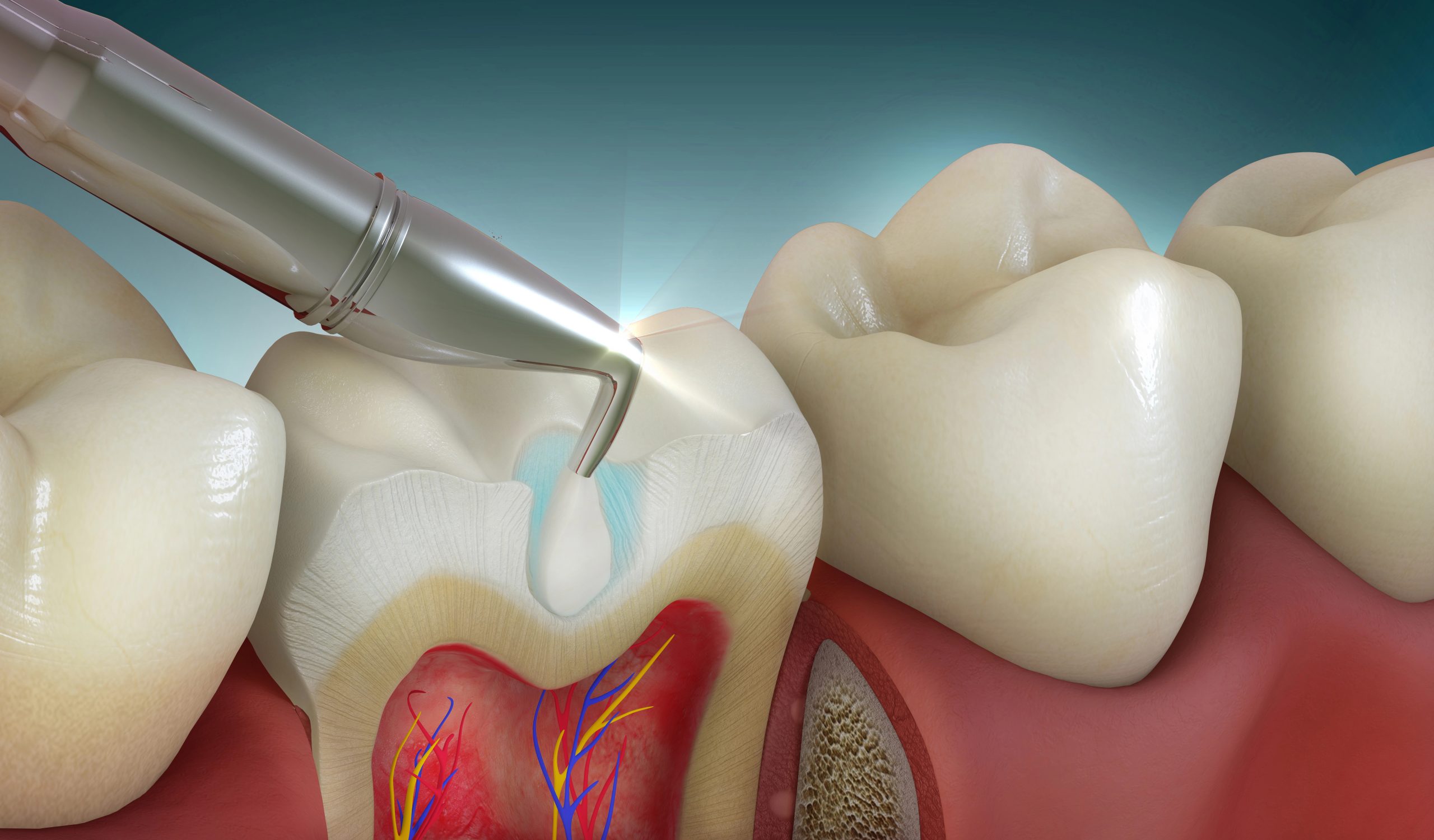 What Should You Expect During a Dental Filling Appointment in Meridian?