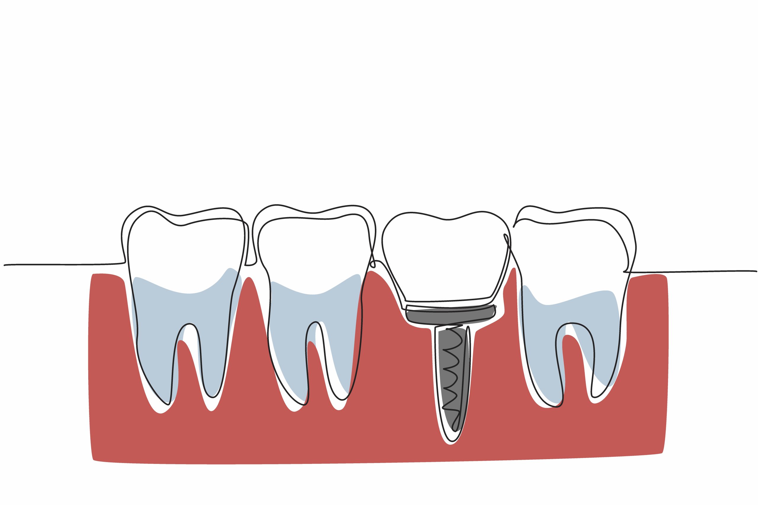 Will Dental Implants Feel Like My Own Natural Teeth Once They’re Placed?